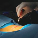 نخستین جراحی لیزری دیسک کمر در بیمارستان کنگان انجام شد